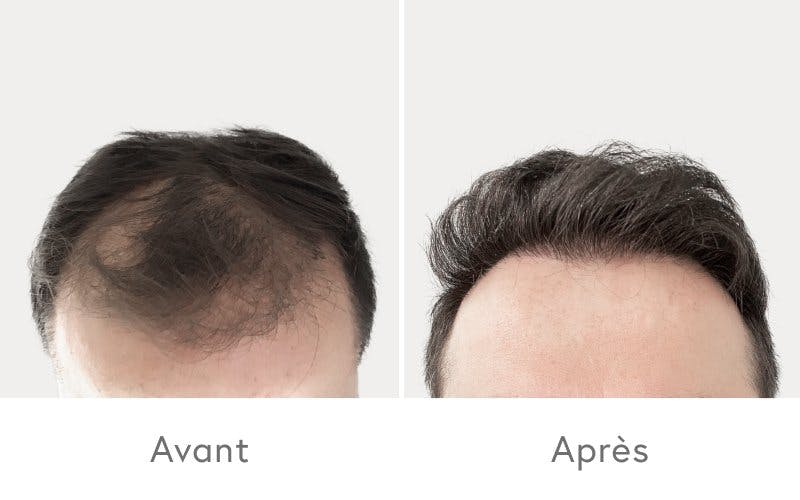 Des résultats impressionnants après une greffe de cheveux chez HAIR & SKIN