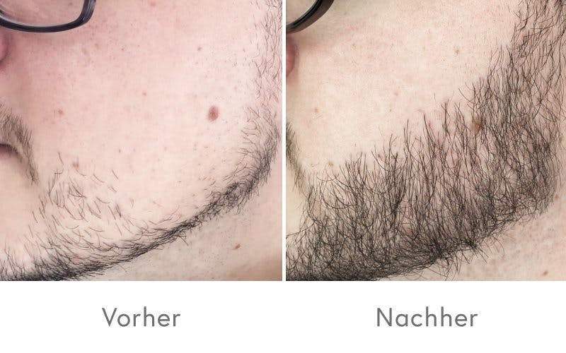 Überzeugende Ergebnisse nach einer Barttransplantation.