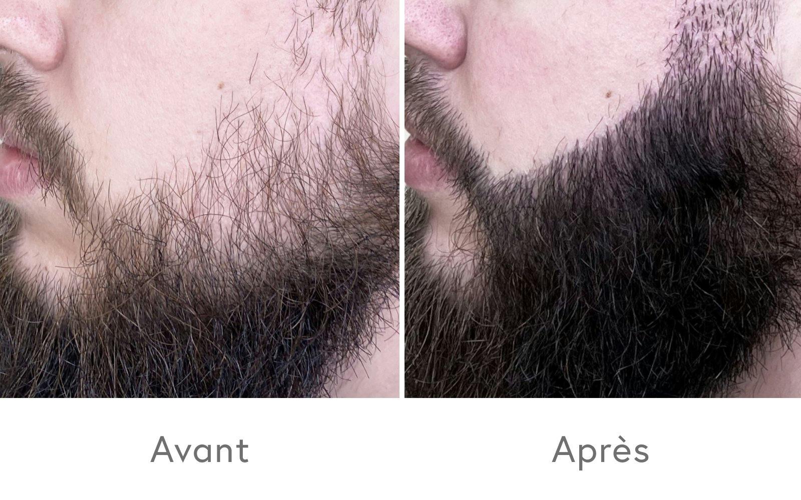 Des résultats convaincants après une greffe de barbe.