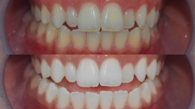 Ein strahlendes Lächeln in kürzester Zeit: So einfach gehts!