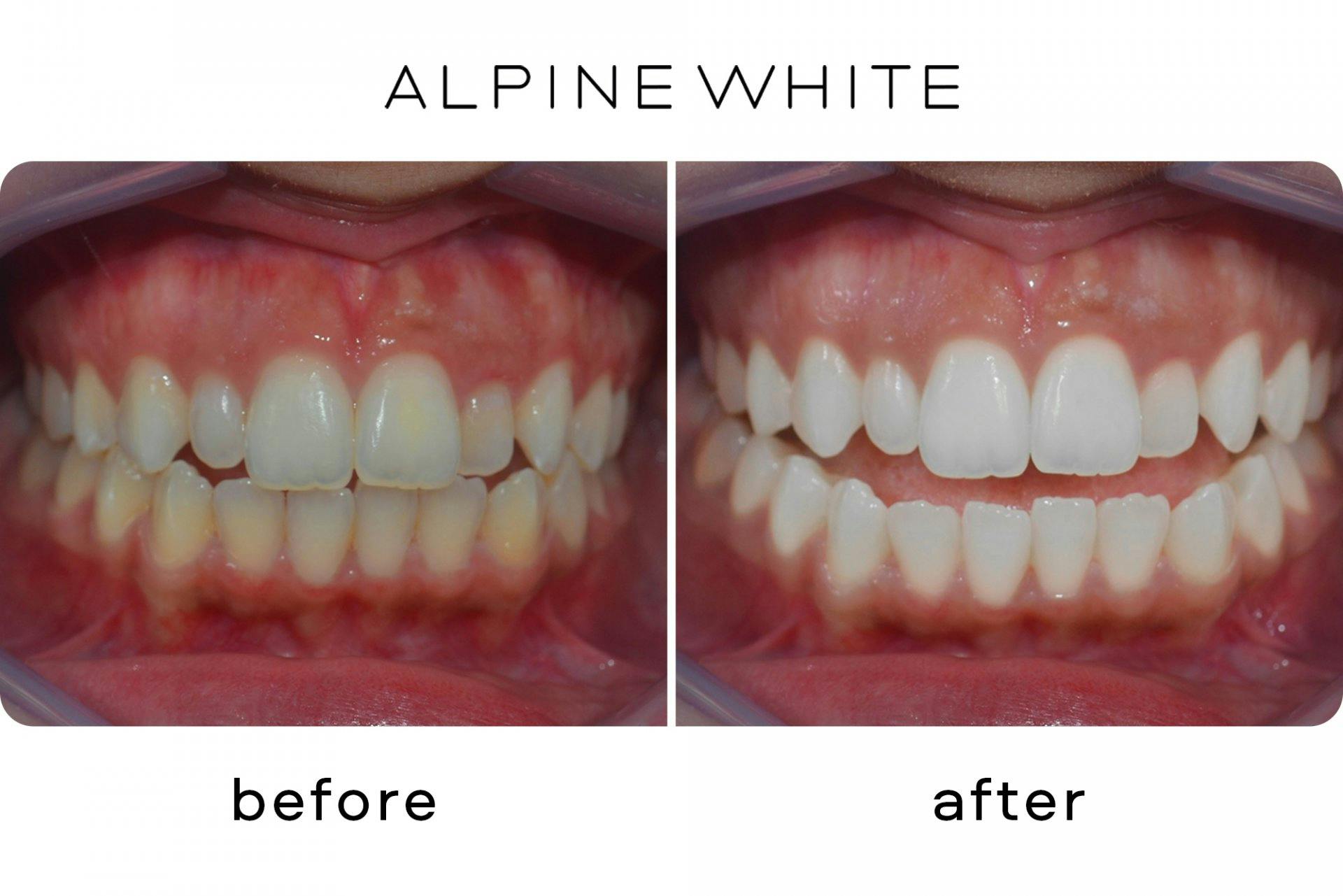 Der Vorher-Nachher-Vergleich zeigt: Dieses Bleaching hält, was es verspricht!