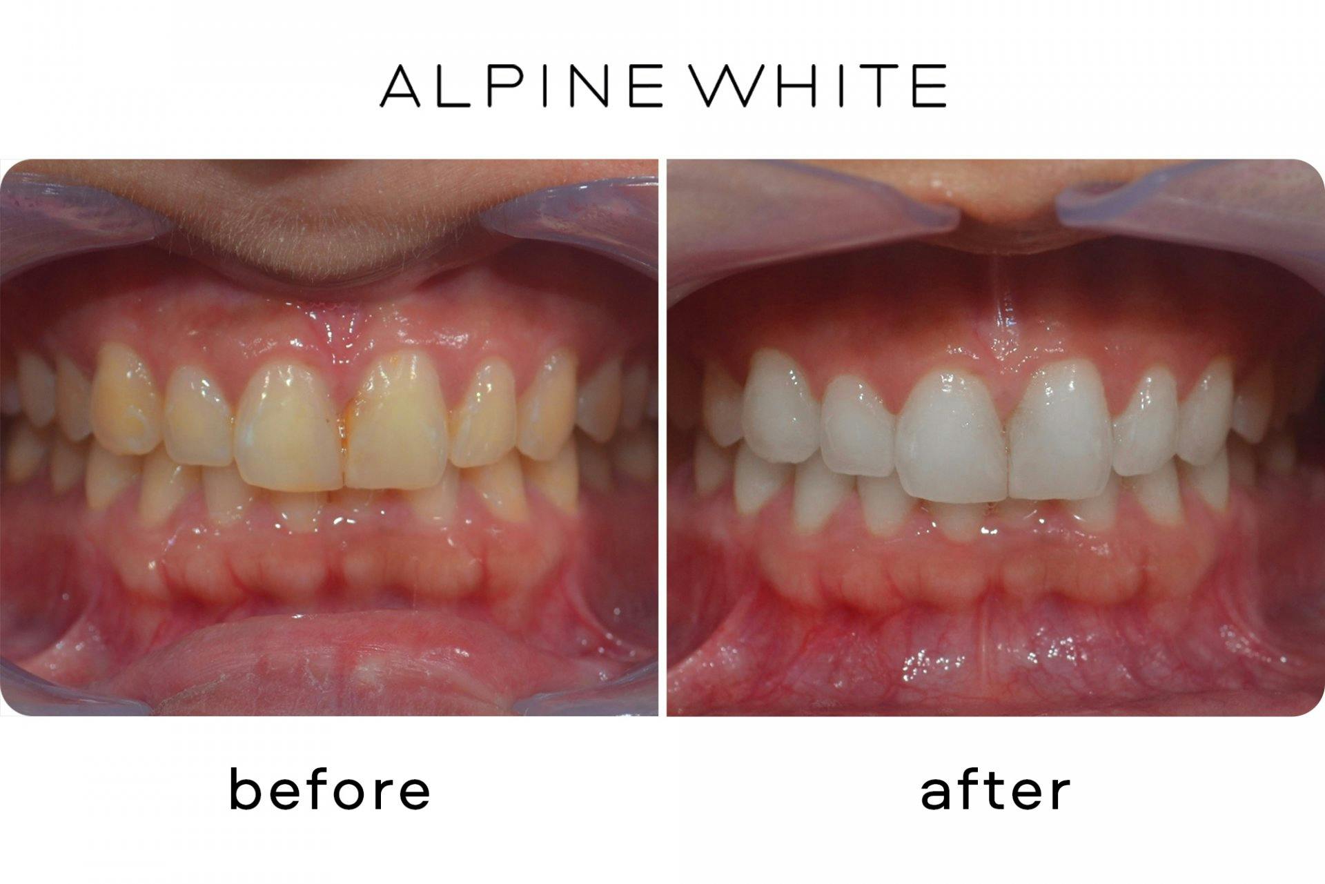 Auch hartnäckige Verfärbungen verblassen mit dem Alpine White Bleaching.