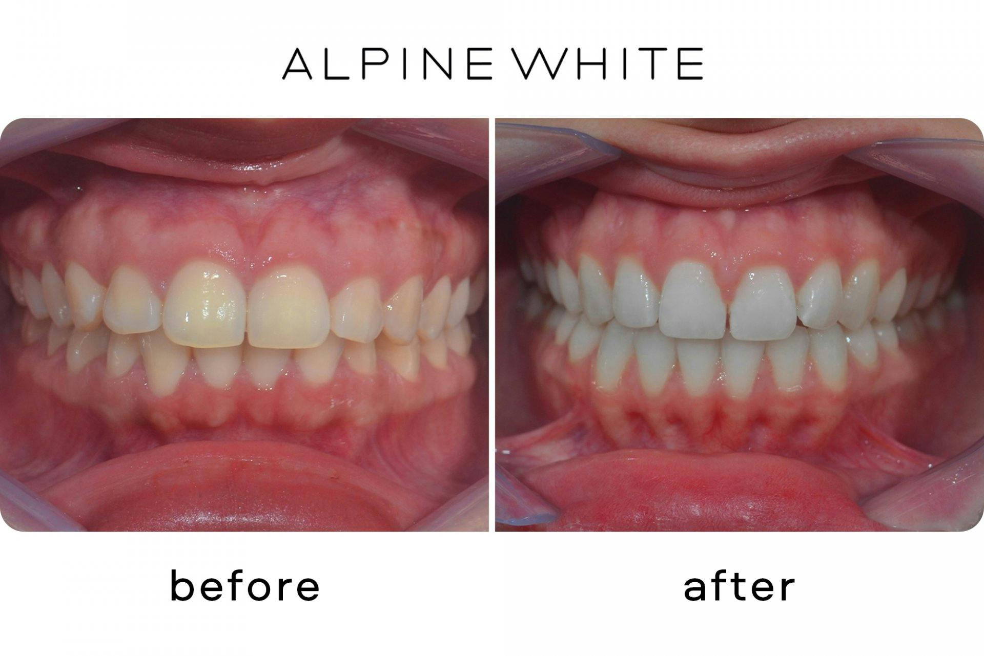 Endlich wieder weisse Zähne!