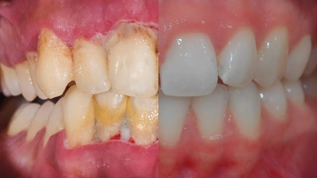 Der Vergleich beweist: Eine professionelle Zahnreinigung kann Wunder bewirken. Der Vergleich beweist: Eine professionelle Zahnreinigung kann Wunder bewirken.