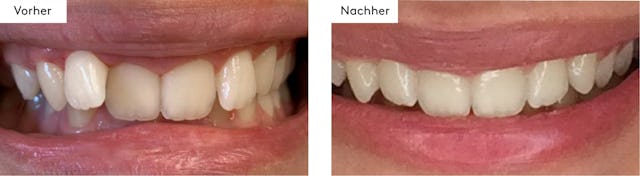 12 Schienen, 6 Monate Behandlungszeit