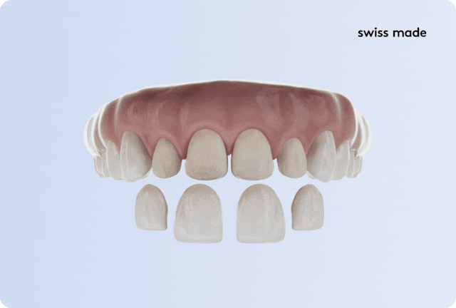 So funktionieren Veneers.