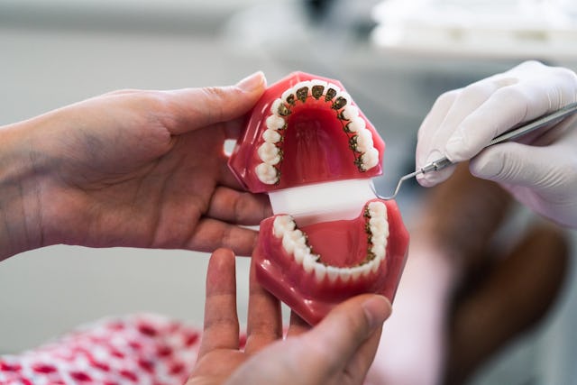 Wird bei Adent professionell gemacht: die Ausrichtung von Zähnen mit Brackets, die auf die Innenflächen geklebt werden.