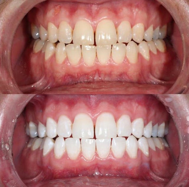 Professionelles Zahnbleaching: vorher/nachher.