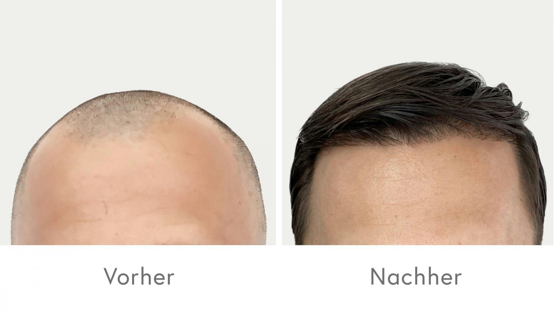 Beeindruckende Ergebnisse nach der Haartransplantation bei HAIR & SKIN.
