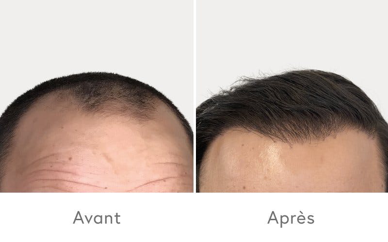 Des résultats impressionnants après une greffe de cheveux chez HAIR & SKIN