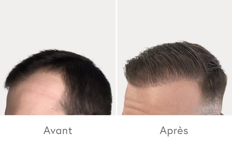 Des résultats impressionnants après une greffe de cheveux chez HAIR & SKIN