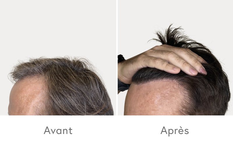 Des résultats impressionnants après une greffe de cheveux chez HAIR & SKIN