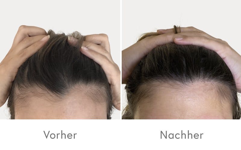 Beeindruckende Ergebnisse nach der Haartransplantation bei HAIR & SKIN