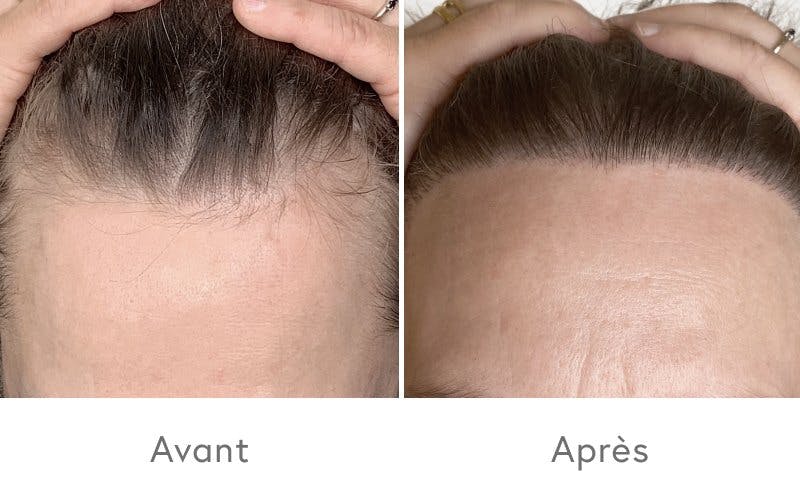 Des résultats impressionnants après une greffe de cheveux chez HAIR & SKIN.
